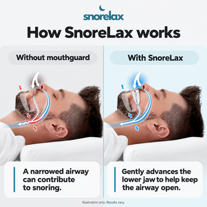 SnoreLax Pro Mouthguard